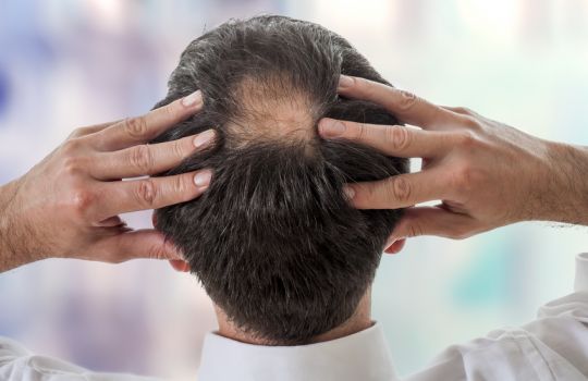 Mann mit beginnender Glatzenbildung in der Scheitelmitte.
