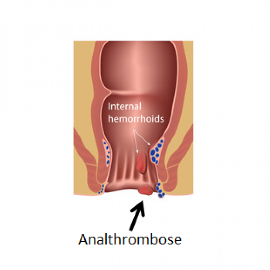 Grafik mit Lokalisation einer Analvenenthrombose. 