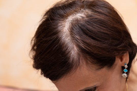 Bei Frauen lichten sich die Haare im Bereich des Mittelscheitels.