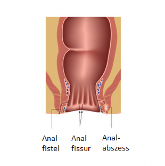Grafik des Enddarms mit Analfistel, Analfissur und Analabszess.